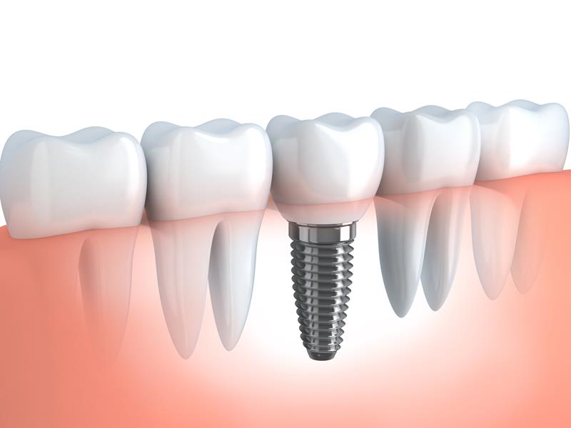 Dental Implants  Skaneateles, NY 